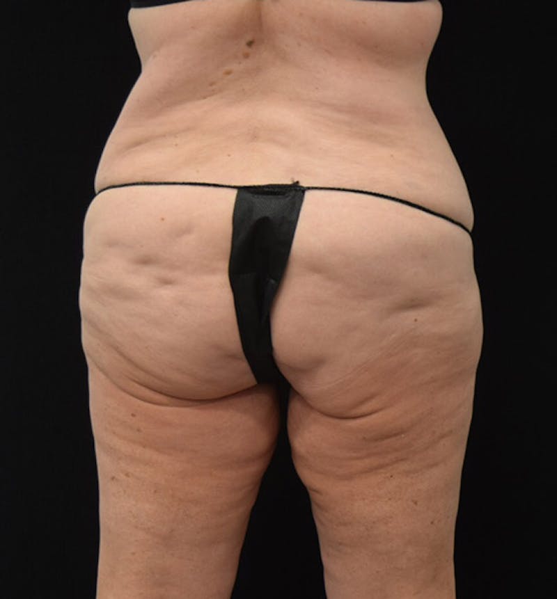 Lower Body Lift Before & After Gallery - Patient 102425763 - Image 11