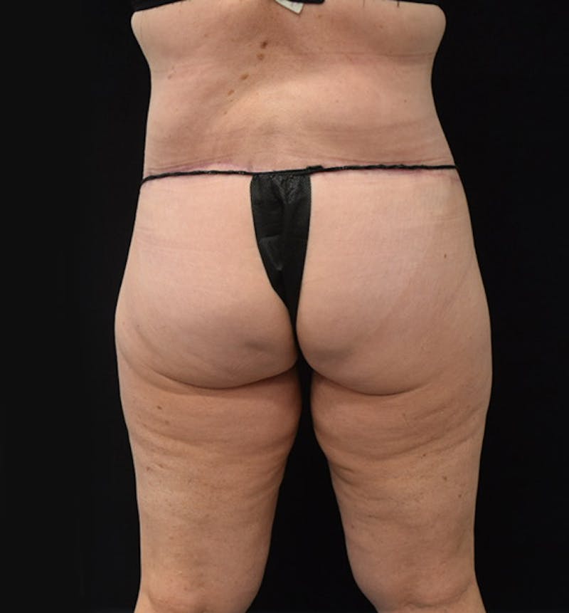 Lower Body Lift Before & After Gallery - Patient 102425763 - Image 12