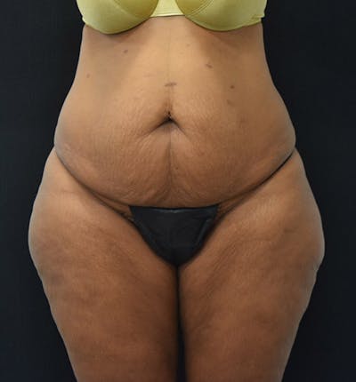 Lower Body Lift Before & After Gallery - Patient 102425991 - Image 1