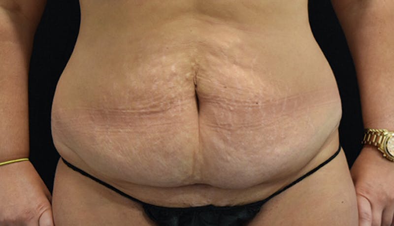 Abdominoplasty Before & After Gallery - Patient 102433692 - Image 1