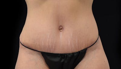 Abdominoplasty Before & After Gallery - Patient 102433692 - Image 2