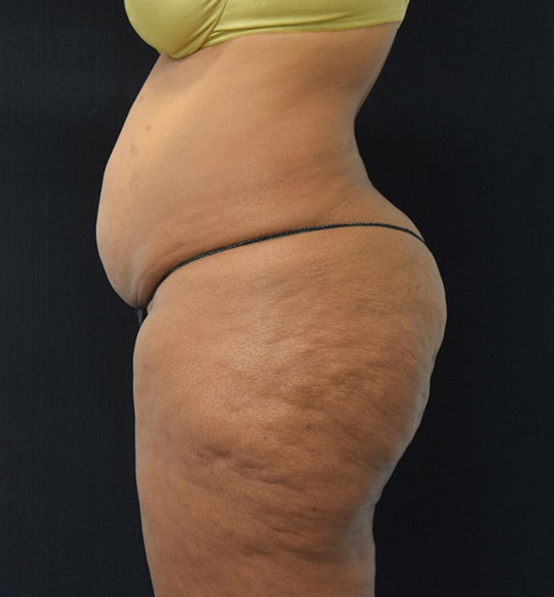 Lower Body Lift Before & After Gallery - Patient 102425991 - Image 5