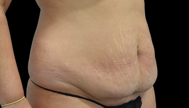 Abdominoplasty Before & After Gallery - Patient 102433692 - Image 3