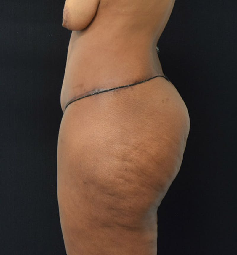 Lower Body Lift Before & After Gallery - Patient 102425991 - Image 6