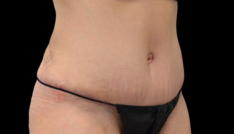 Abdominoplasty Before & After Gallery - Patient 102433692 - Image 4