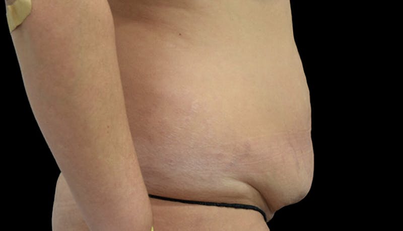 Abdominoplasty Before & After Gallery - Patient 102433692 - Image 5