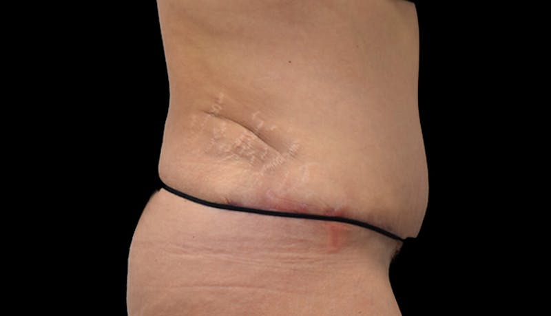 Abdominoplasty Before & After Gallery - Patient 102433692 - Image 6