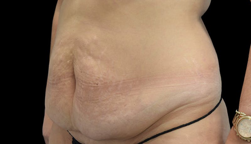 Abdominoplasty Before & After Gallery - Patient 102433692 - Image 7