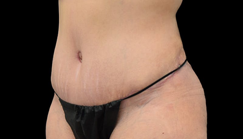 Abdominoplasty Before & After Gallery - Patient 102433692 - Image 8