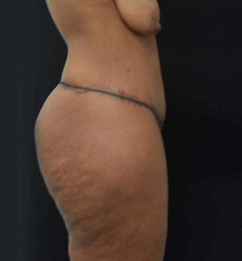 Lower Body Lift Before & After Gallery - Patient 102425991 - Image 10
