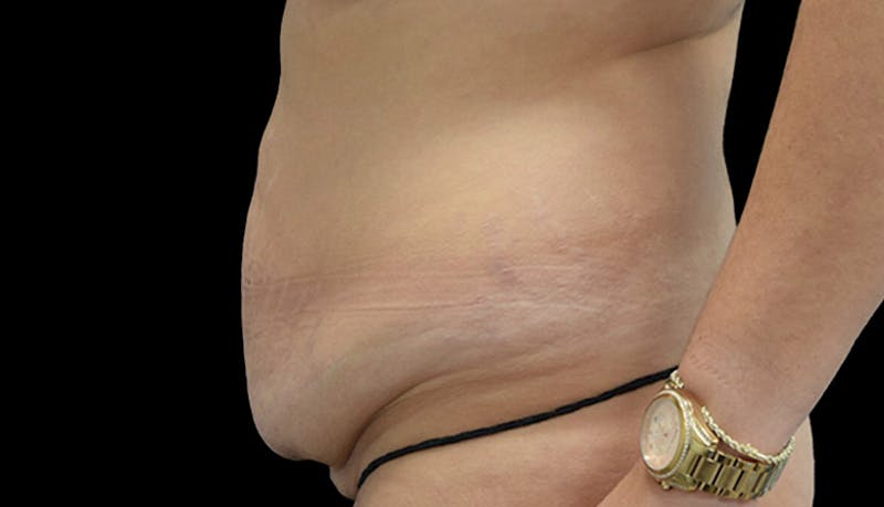 Abdominoplasty Before & After Gallery - Patient 102433692 - Image 9