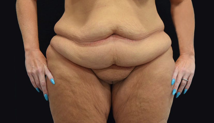 Weight Loss