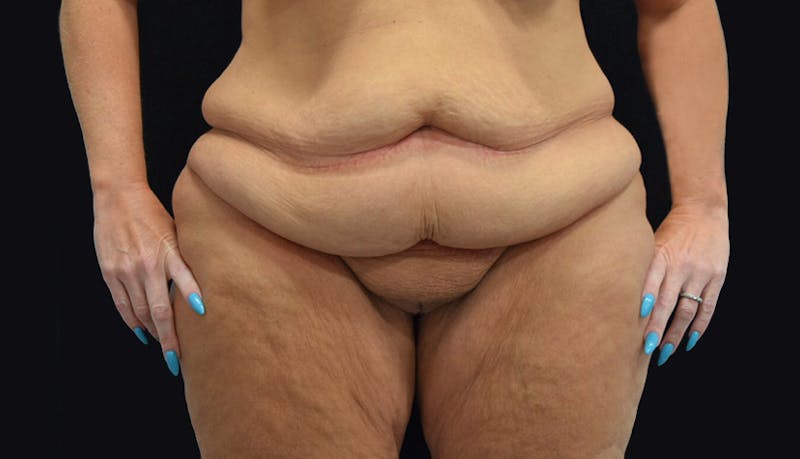 Massive Weight Loss Before & After Gallery - Patient 102433703 - Image 1