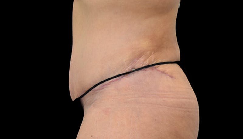 Abdominoplasty Before & After Gallery - Patient 102433692 - Image 10