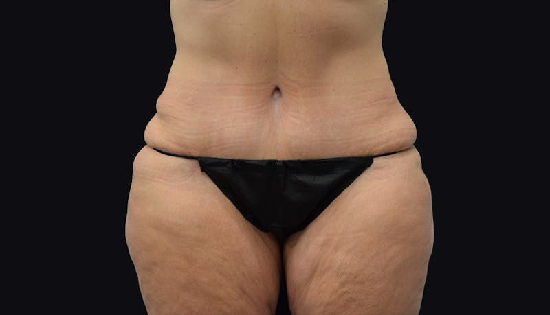 Massive Weight Loss Before & After Gallery - Patient 102433703 - Image 2