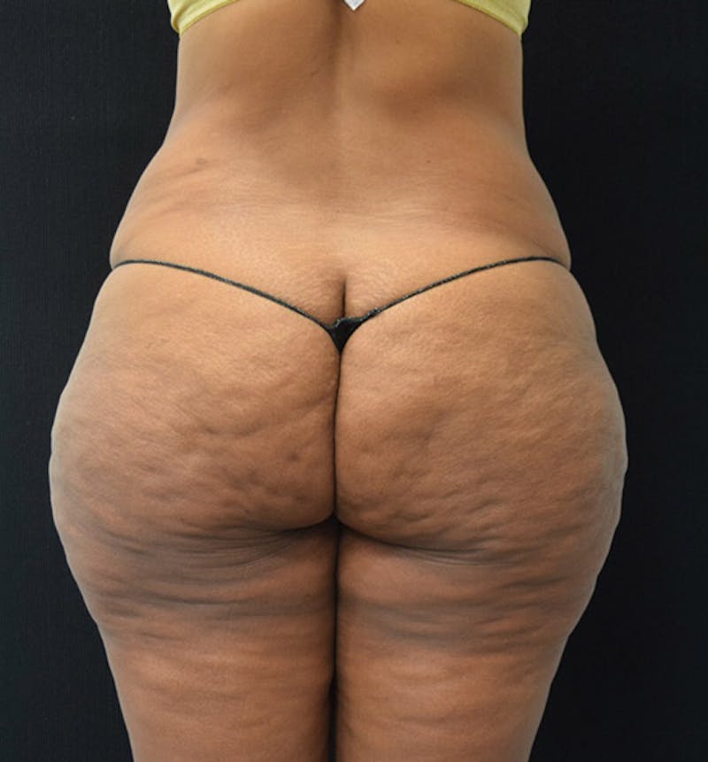 Lower Body Lift Before & After Gallery - Patient 102425991 - Image 11