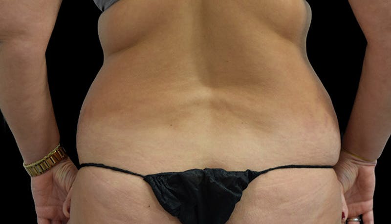 Abdominoplasty Before & After Gallery - Patient 102433692 - Image 11