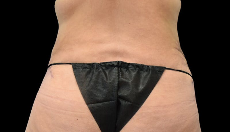Abdominoplasty Before & After Gallery - Patient 102433692 - Image 12