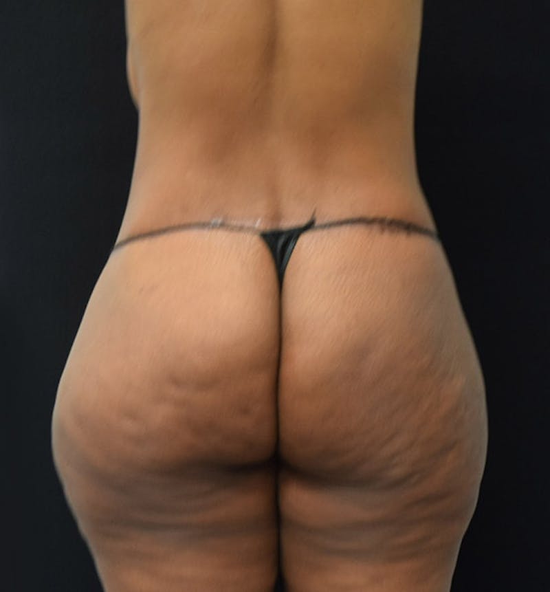 Lower Body Lift Before & After Gallery - Patient 102425991 - Image 12