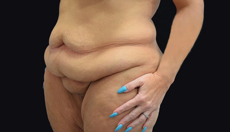 Massive Weight Loss Gallery - Patient 102433703 - Image 3