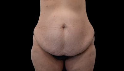 Abdominoplasty Before & After Gallery - Patient 102433767 - Image 1