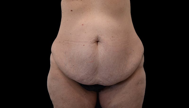 Abdominoplasty Before & After Gallery - Patient 102433767 - Image 1