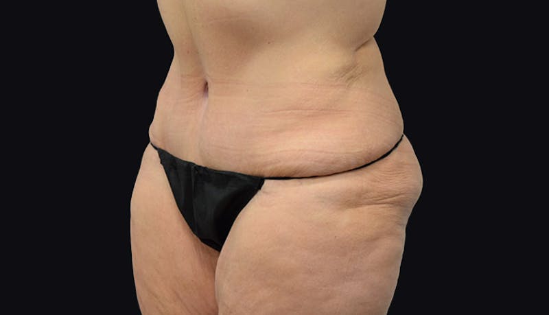 Massive Weight Loss Gallery - Patient 102433703 - Image 4