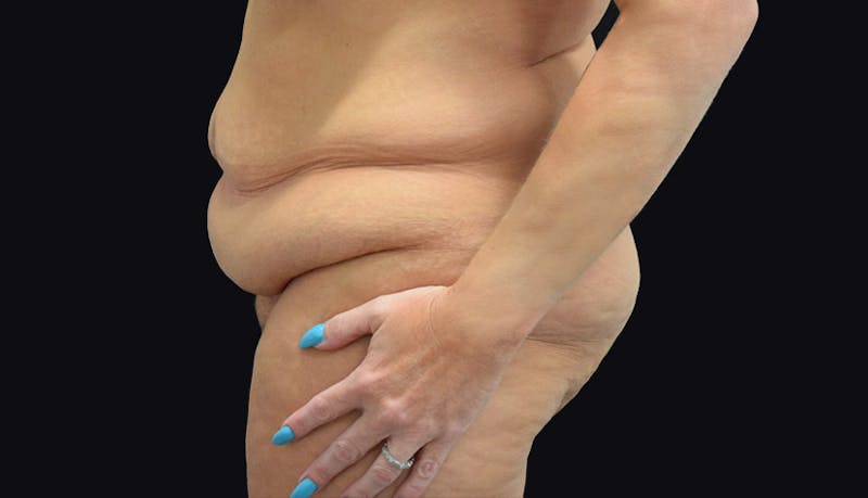 Massive Weight Loss Before & After Gallery - Patient 102433703 - Image 5