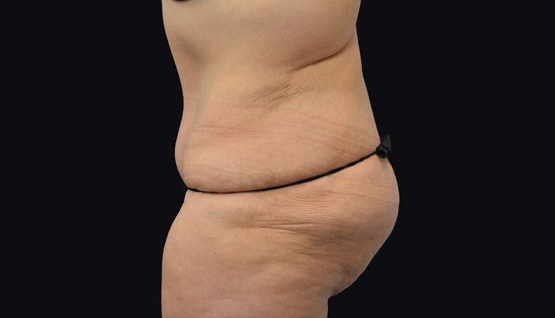 Massive Weight Loss Before & After Gallery - Patient 102433703 - Image 6