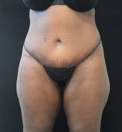 Lower Body Lift Before & After Gallery - Patient 102433742 - Image 2