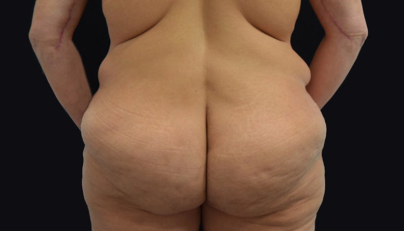 Massive Weight Loss Before & After Gallery - Patient 102433703 - Image 7