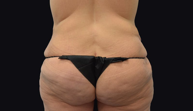Massive Weight Loss Gallery - Patient 102433703 - Image 8