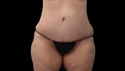 Abdominoplasty Before & After Gallery - Patient 102433767 - Image 2