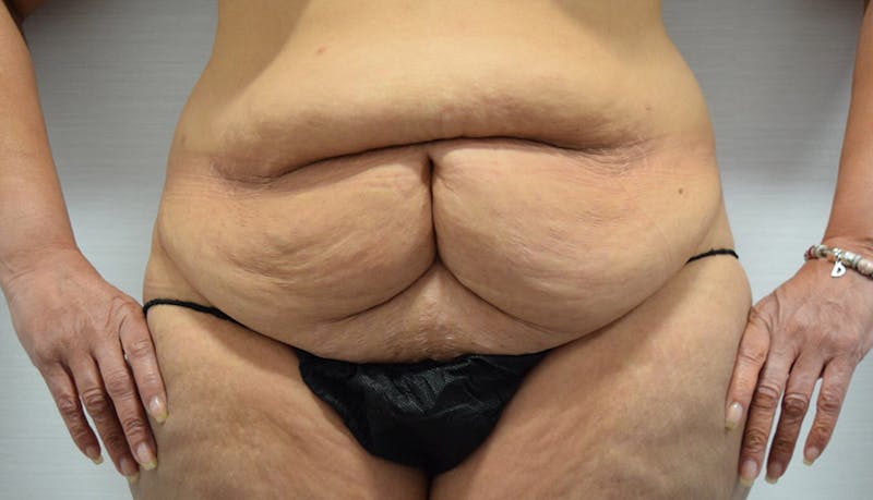 Massive Weight Loss Before & After Gallery - Patient 102433792 - Image 1