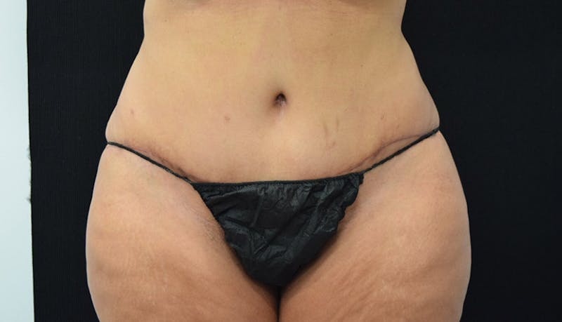Massive Weight Loss Gallery - Patient 102433792 - Image 2