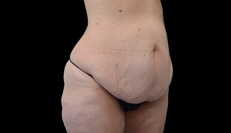 Abdominoplasty Before & After Gallery - Patient 102433767 - Image 3