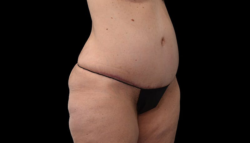 Abdominoplasty Before & After Gallery - Patient 102433767 - Image 4
