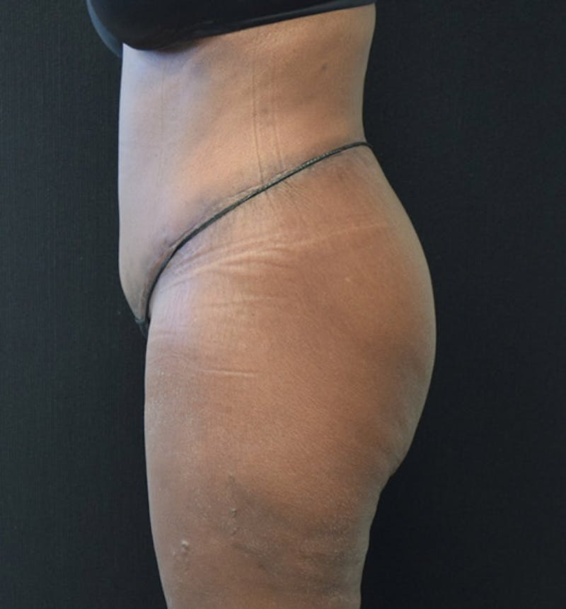 Lower Body Lift Before & After Gallery - Patient 102433742 - Image 6