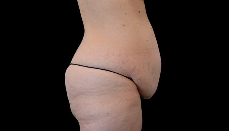 Abdominoplasty Before & After Gallery - Patient 102433767 - Image 5
