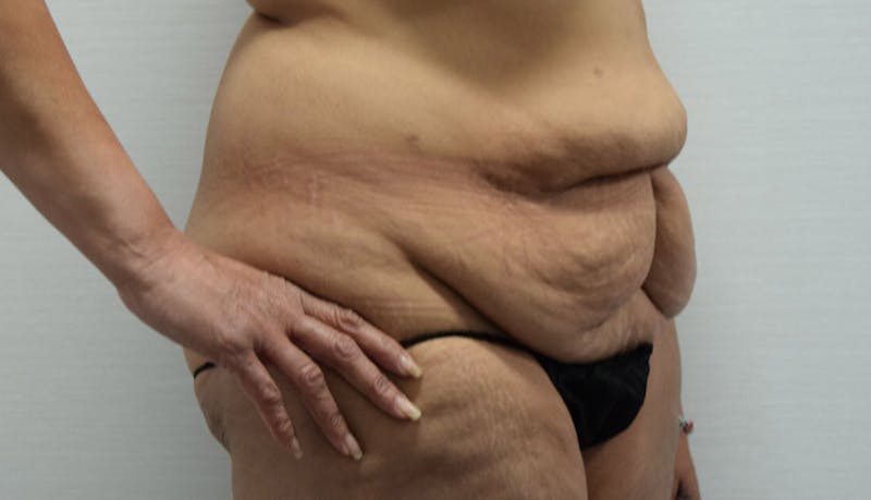 Massive Weight Loss Before & After Gallery - Patient 102433792 - Image 3