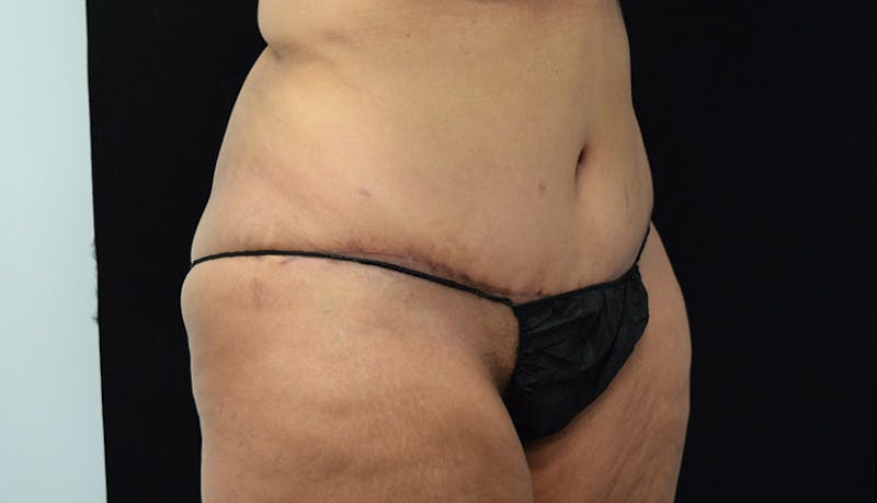 Massive Weight Loss Gallery - Patient 102433792 - Image 4