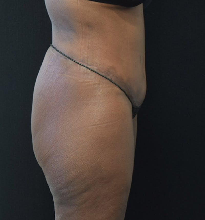 Lower Body Lift Gallery - Patient 102433742 - Image 10
