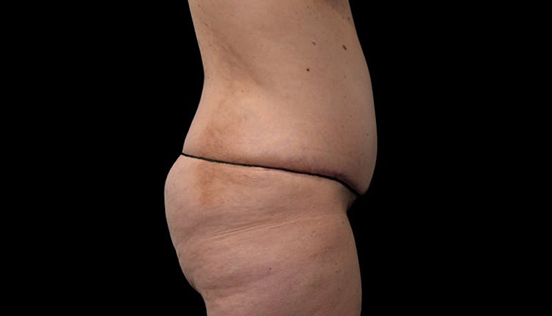 Abdominoplasty Before & After Gallery - Patient 102433767 - Image 6