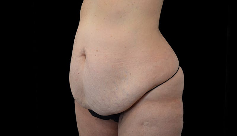 Abdominoplasty Before & After Gallery - Patient 102433767 - Image 7