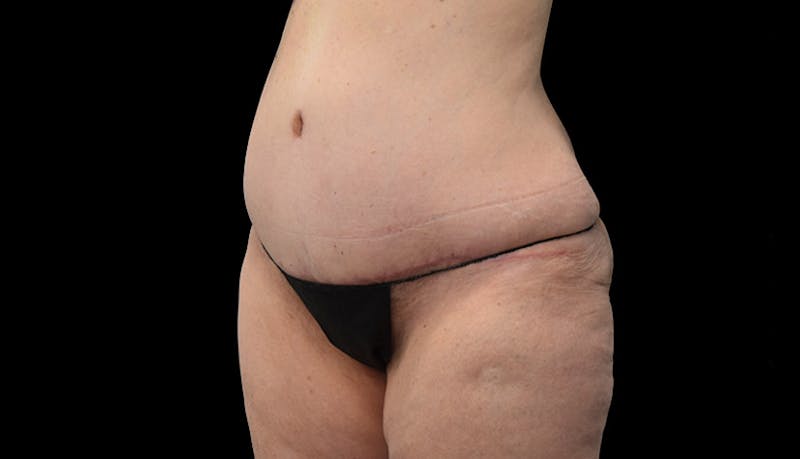 Abdominoplasty Before & After Gallery - Patient 102433767 - Image 8