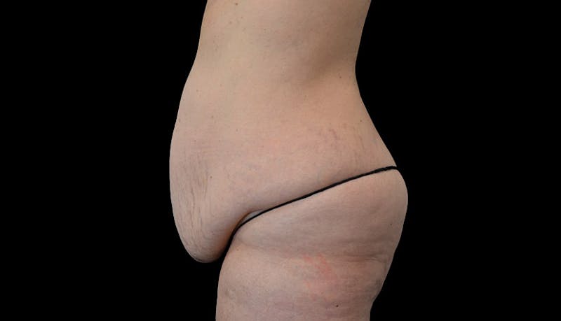 Abdominoplasty Before & After Gallery - Patient 102433767 - Image 9