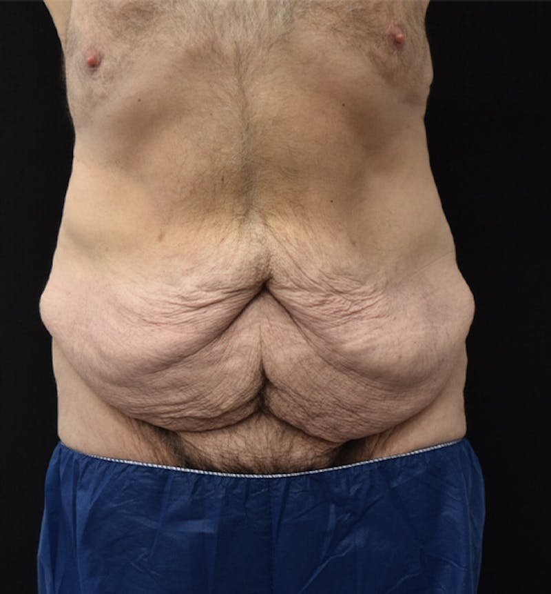 Lower Body Lift Before & After Gallery - Patient 148037526 - Image 1