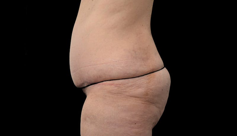 Abdominoplasty Before & After Gallery - Patient 102433767 - Image 10