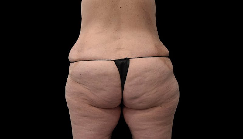 Abdominoplasty Before & After Gallery - Patient 102433767 - Image 11