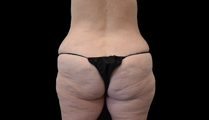Abdominoplasty Before & After Gallery - Patient 102433767 - Image 12